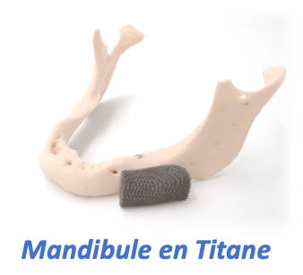 Mandibule en titane